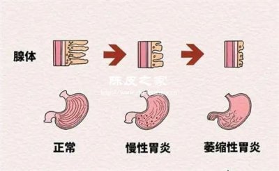 陈皮+抗抑郁药协同治疗焦虑型胃肠病