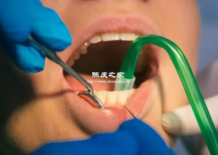 拔牙后可以吃陈皮吗？拔牙后的注意事项！